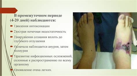 Синдром длительного сдавления - презентация онлайн