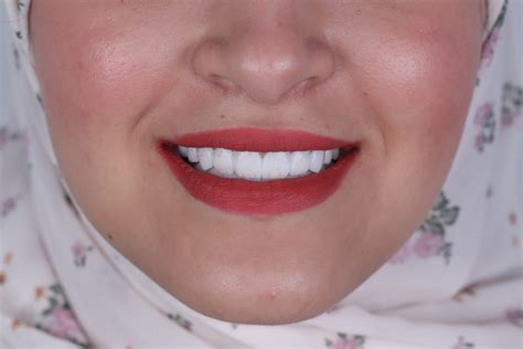 Dental Surgery - Glowy Dental Clinincs