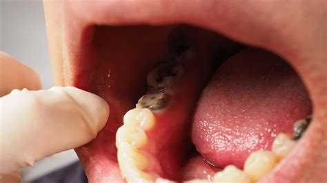 What Is Dry Socket Condition After Tooth Extraction, Dentist Explains ...