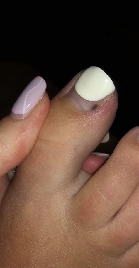 Noticed a black line earlier in week in nail bed then on Thursday it