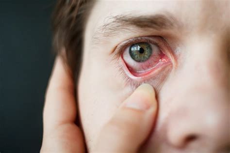 Spring Allergies and Managing Your Itchy, Red Eyes: Andrea J. Stein, OD: Optometrist