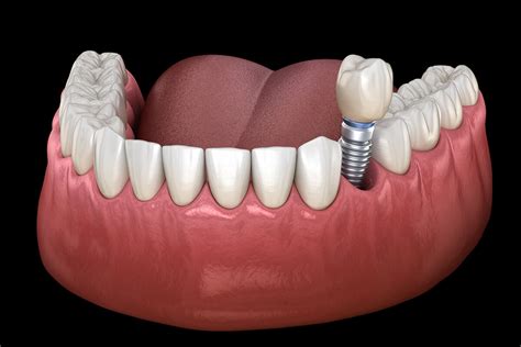 choosing  periodontist  lasting dental implants