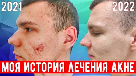 Как я вылечил акне и сколько стоило избавиться от прыщей. - YouTube