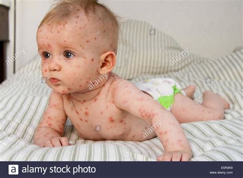 chicken pox in infant - pictures, photos