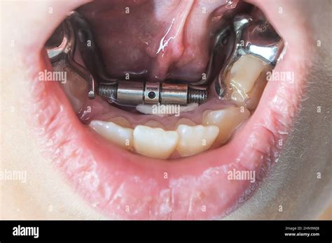 little girl with a plate on her teeth Stock Photo - Alamy