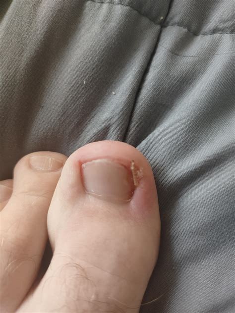 Stubbed my toe and ripped part of nail off : r/mildlyinfuriating