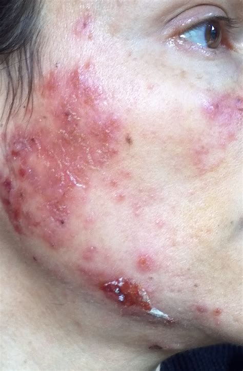 healthyself: Bu Zhong Yi Qi Tang and MRSA