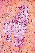 Perineural invasion - Libre Pathology