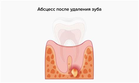 Боль после удаления зуба | Стоматология Митино