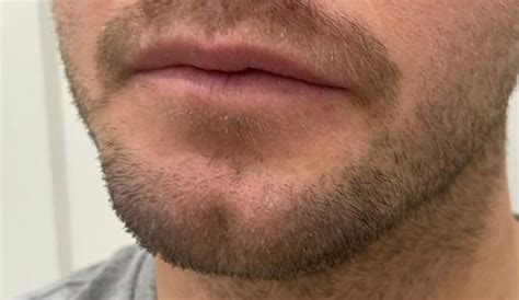 cleft chin treatment adelaide enhance    expert care