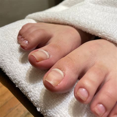 Learn what ingrown toenails are and how to prevent them — Onyx