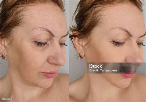 Enrugar Ou Enrrugar - Foto de Mulher Enrugar Antes E Depois Do Tratamento e mais fotos de ...