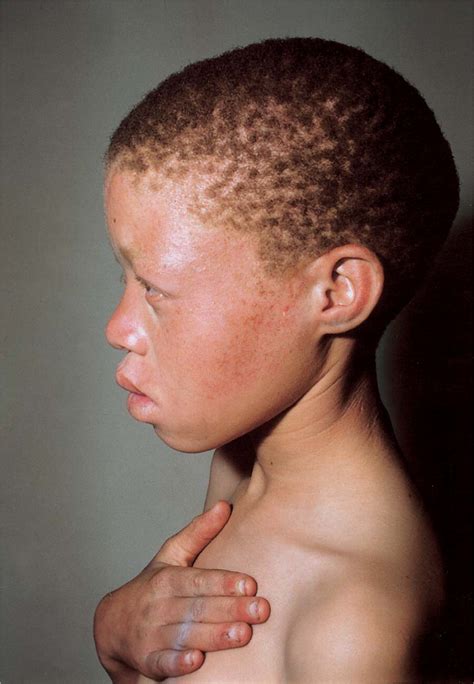 In Southern Africa, Brown Oculocutaneous Albinism (BOCA) Maps to the ...