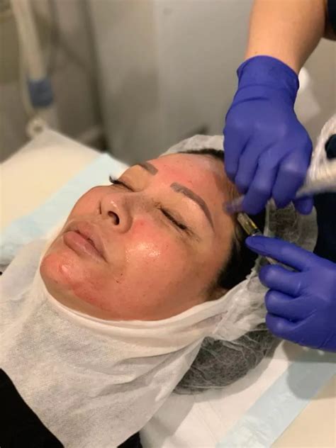 What is PRP skin treatment? - Hair & Skin Science