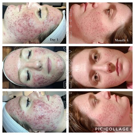 Cystic Acne — The Acne Lab