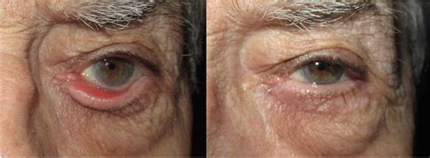 Ectropion Repair — Moyes Eye Center
