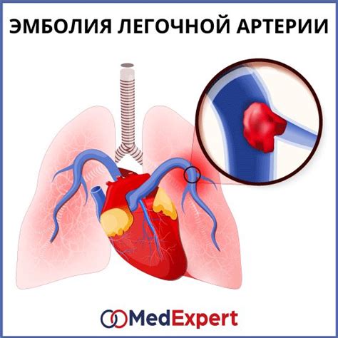Эмболия легочной артерии | Pulmonary embolism, Pulmonary, Vein thrombosis