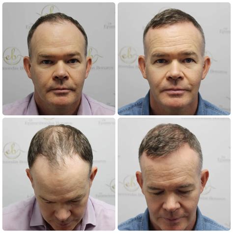 choose  hair transplant clinic dr bonaros