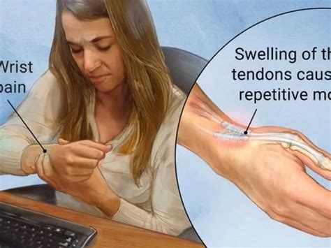 De Quervain Tendon Release Surgery Explained, 52% OFF
