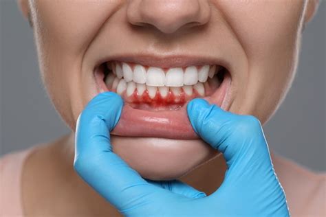 The Types of Gum Disease - Soft Touch Dental Queens New York