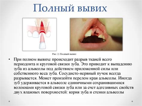 Вывихи и переломы зубов - презентация онлайн