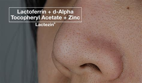 Whiteheads on the Face? Here's What You Shouldn't Be Doing - Lactezin