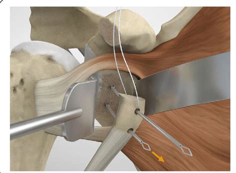 To shuttle and transfer the coracoid process a Suture Retriever is ...