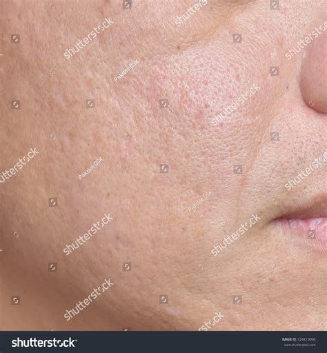 17 How Acne Happens Images, Stock Photos & Vectors | Shutterstock