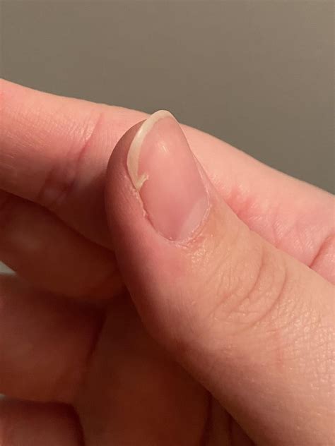 How to fix nails that are broken past the quick? : r/Nails