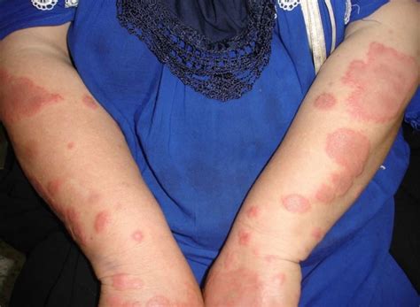 Erythema multiforme causes, types, symptoms, diagnosis and treatment