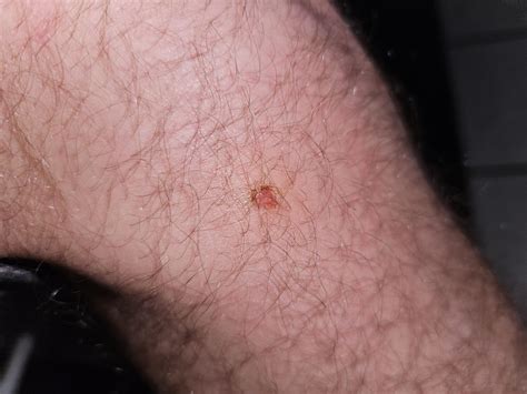 Spider bite ID? : r/spiderbites