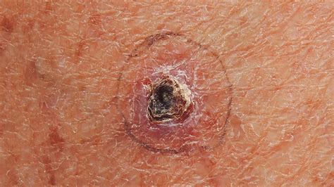 skin cancer signs treatment types  skin cancer melanoma basal