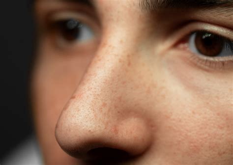 Get Rid of Melasma with Expert Care | Zoe Aesthetic