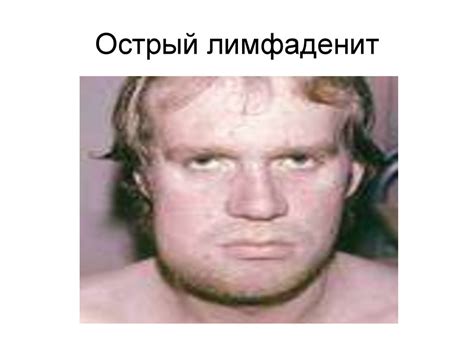 Лимфангит, лимфаденит, абсцесс, флегмона - презентация онлайн