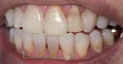 Must pull out teeth?? Pls help : r/askdentists
