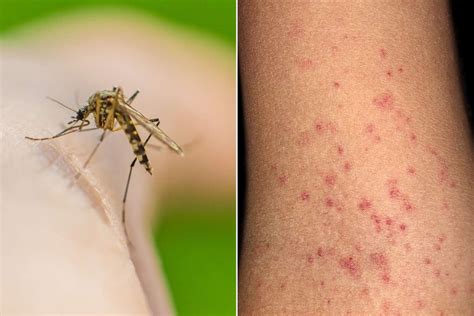 dengue hemorrhagic fever  warning signs