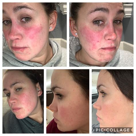 Soolantra Antes E Depois - Soolantra Before And After | Thebrokensealblog