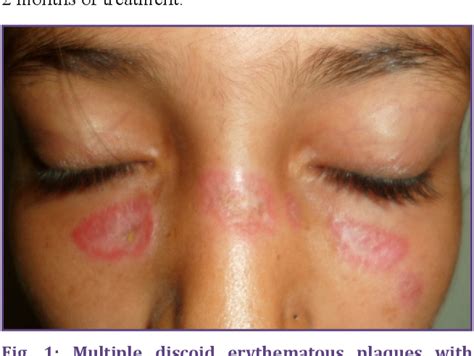 Discoid Lupus Erythematosus