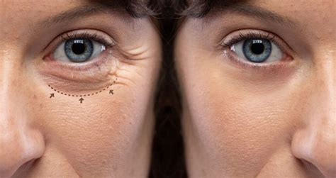 Bolsa Nos Olhos Antes E Depois - Cirurgia Plastica Antes E Depois Dos Olhos Veja O Antes E Depois De