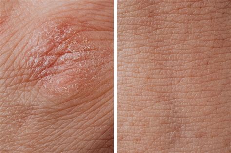 Cancer Support India: Is It Eczema or Just Dry Skin? How to Tell the ...