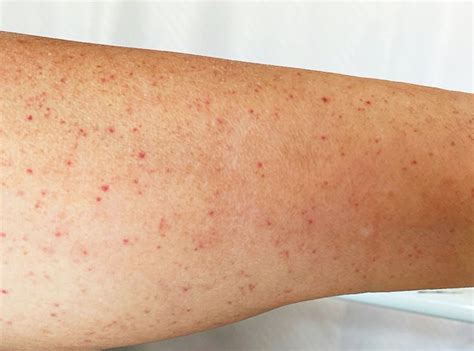 signs  bleeding condition linked  astrazeneca covid jab