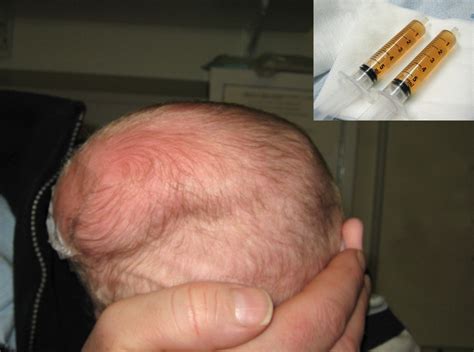 An unusual swelling on an infant's head | ADC Fetal & Neonatal Edition