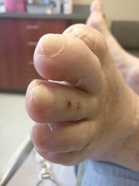 White Patches On Toenails [Causes, Signs & Best Treatment]