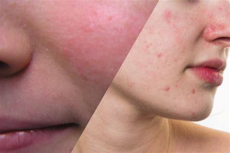 mild rosacea acne