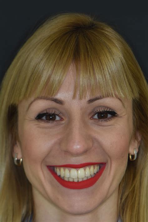Ортодондия и брекети Деймън | ROI Dental Clinic