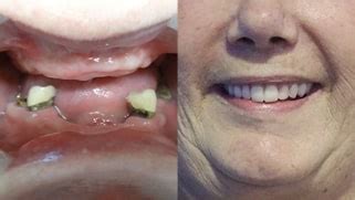 Dentadura Postiza Removible en Tijuana - Snap on Denture