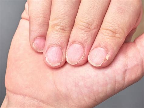 Onycholysis Nail: Causes & Prevention - RemoteDerm