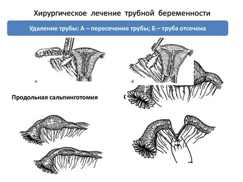 Эктопическая беременность - презентация онлайн