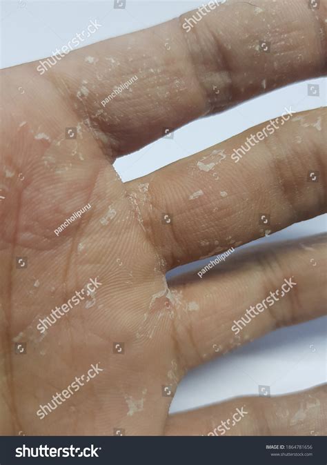 Skin Peeling On Hand Keratolysis Exfoliativa Stock Photo 1864781656 ...