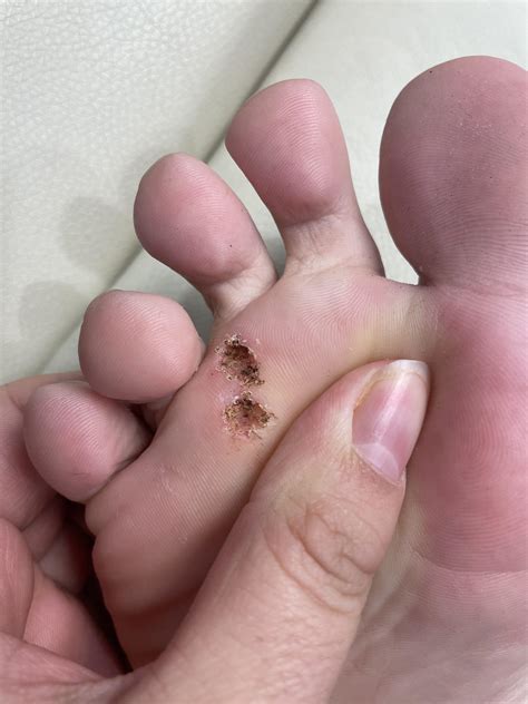 Scoop Out Wart at Wade Diaz blog